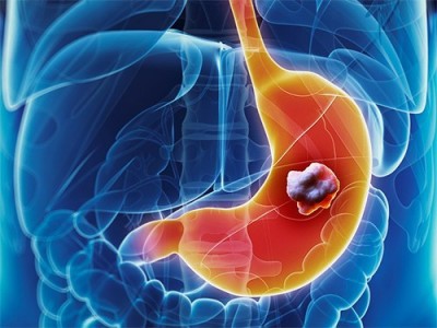 Специальные антитела продлят жизнь пациентов с раком желудка
