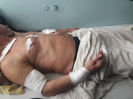 При обстреле Донецка боевиками ВСУ ранение получил мирный житель